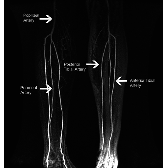 MR Angiography Both Lower Limb